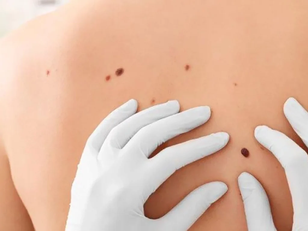 melanoma